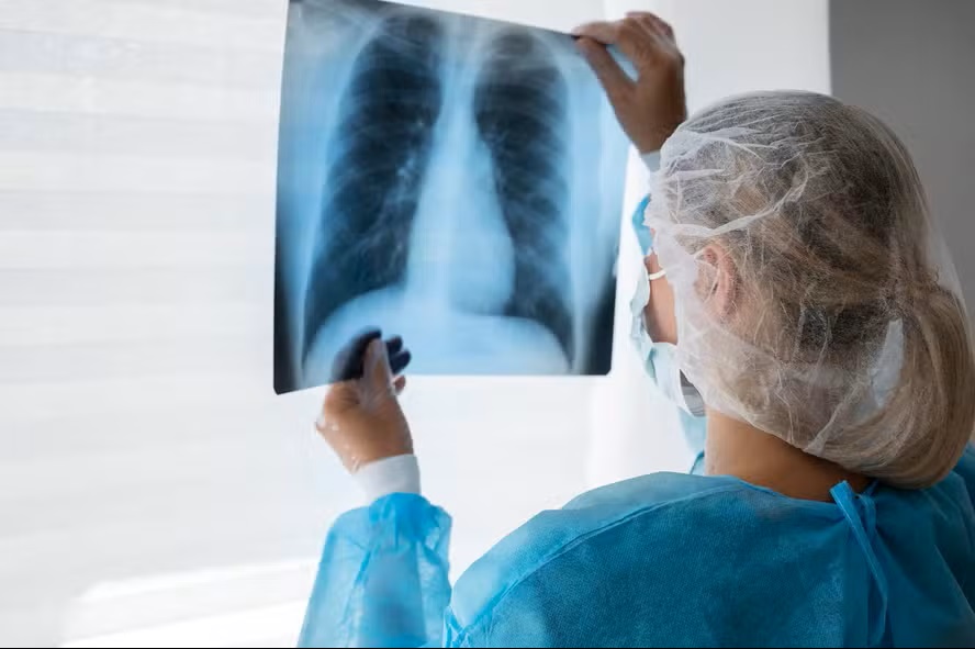 15% dos casos surpreendentes surgem em não fumantes! 1 radiografia do pulmao